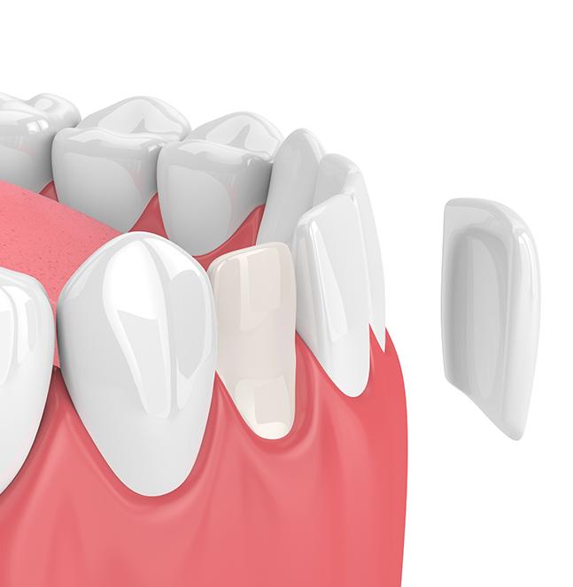 porcelain-veneers-service